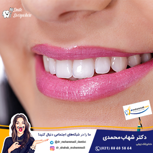 زرد شدن کامپوزیت دندان - کلینیک دندانپزشکی دکتر شهاب محمدی